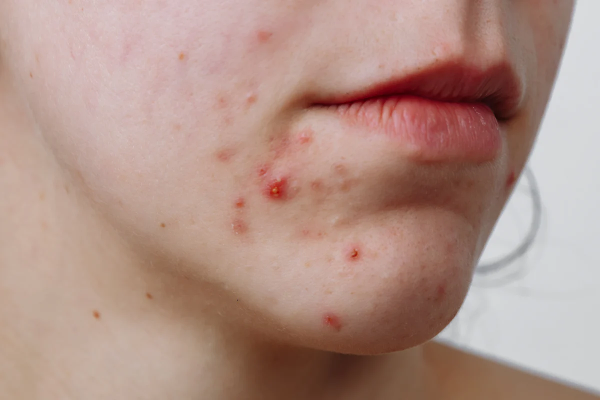 Acne