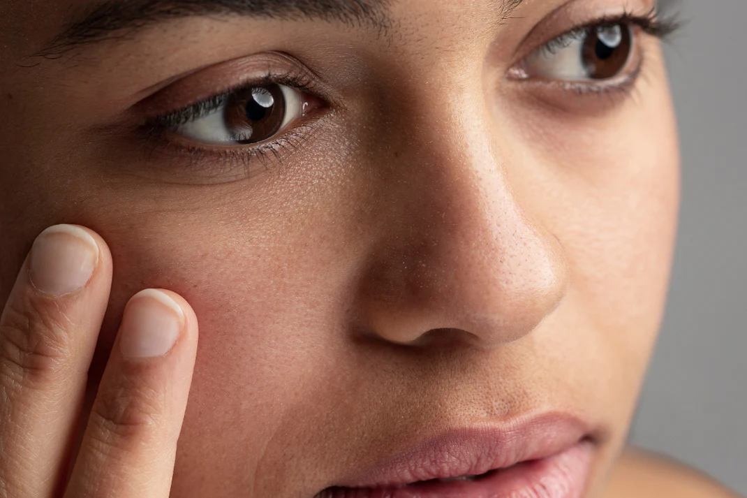 Dark Circles