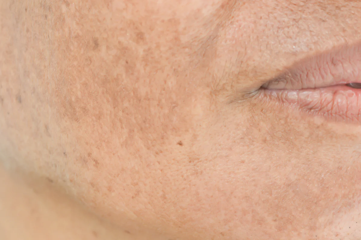 Dark Patches / Melasma