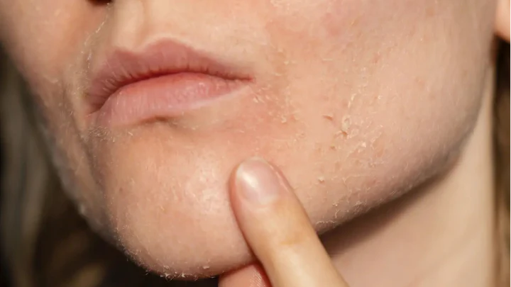 Dry Skin / Dehydration