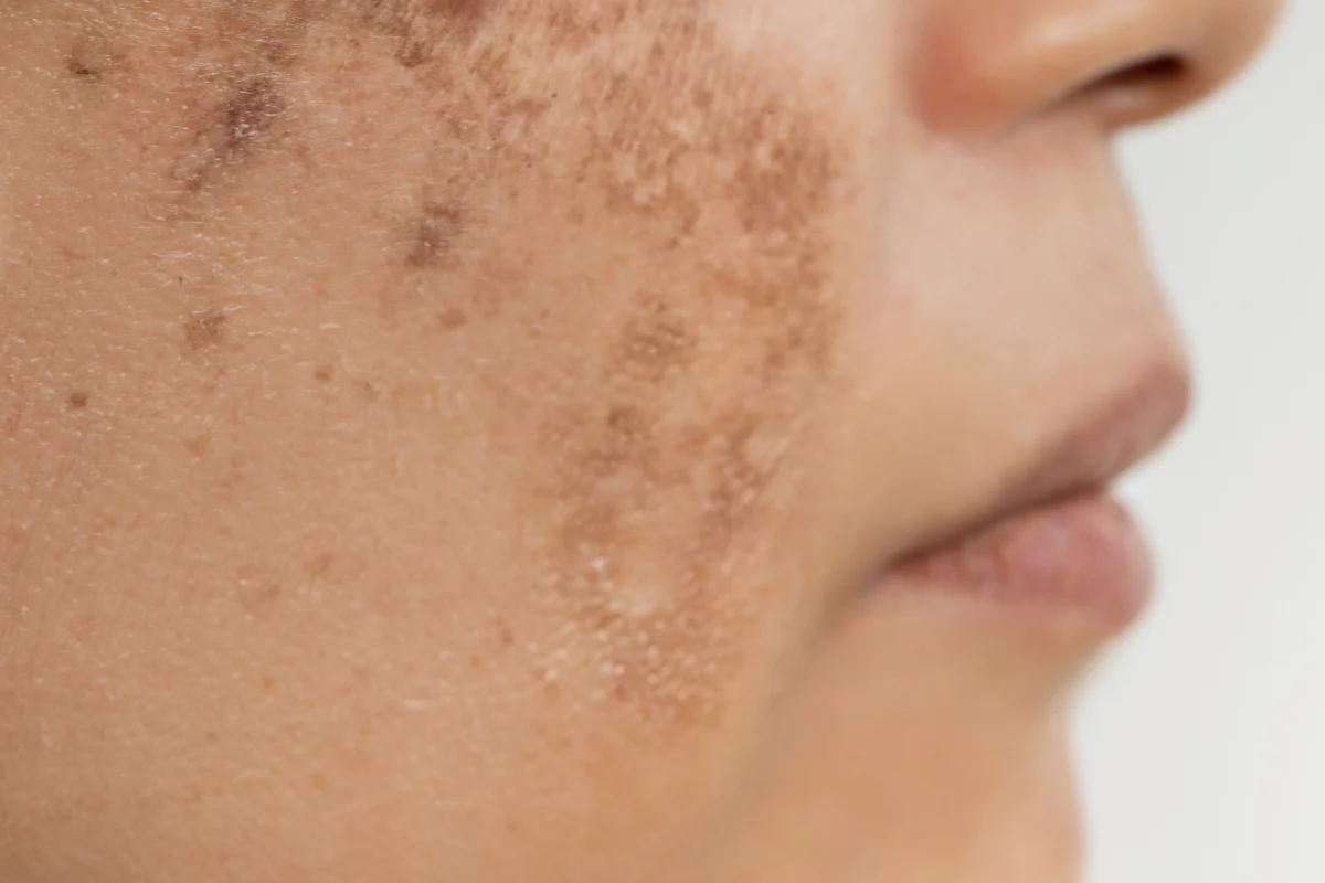 Hyperpigmentation