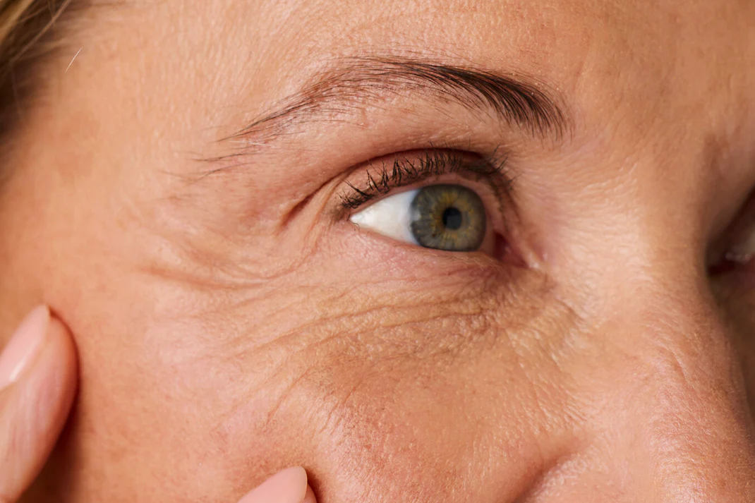Lines & Wrinkles