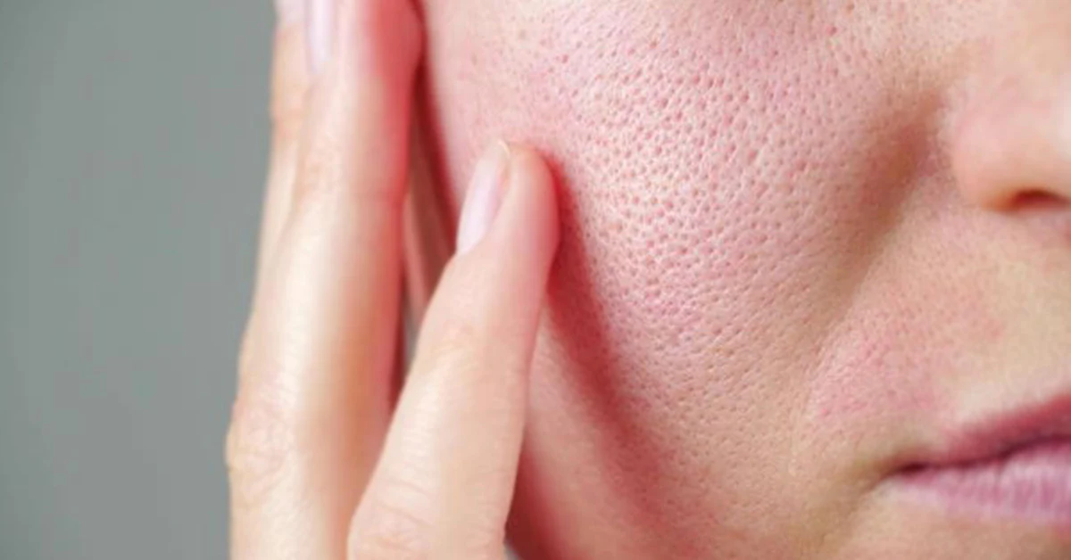 Pores