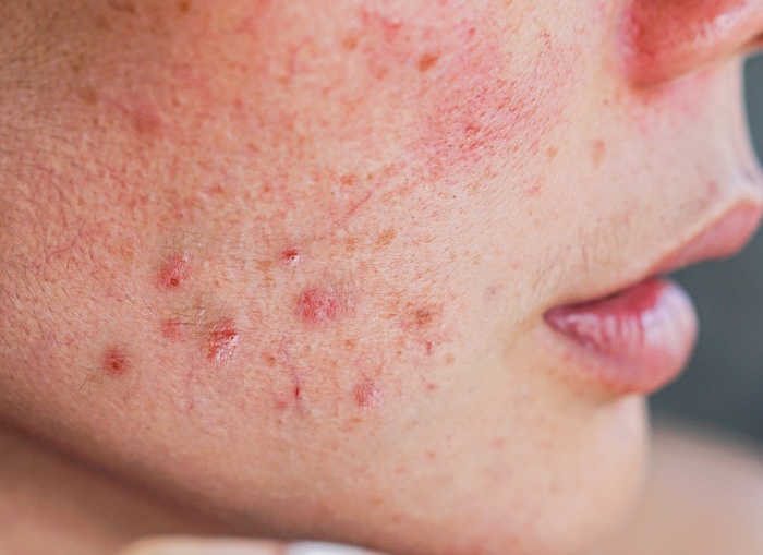 Skin Barrier