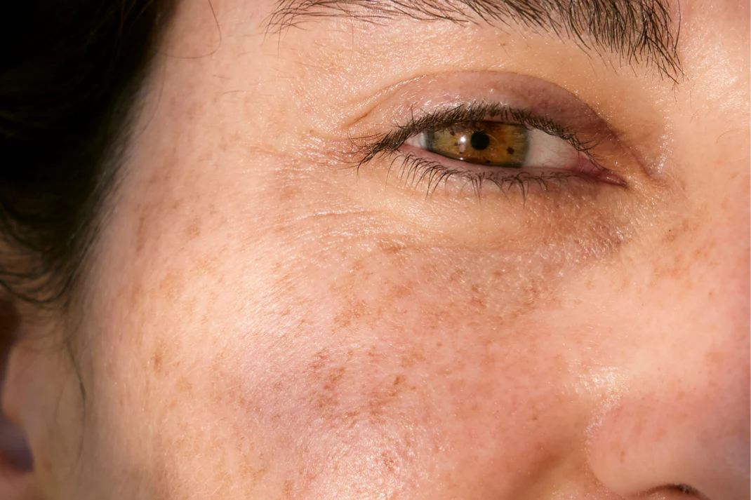 Sun Damage